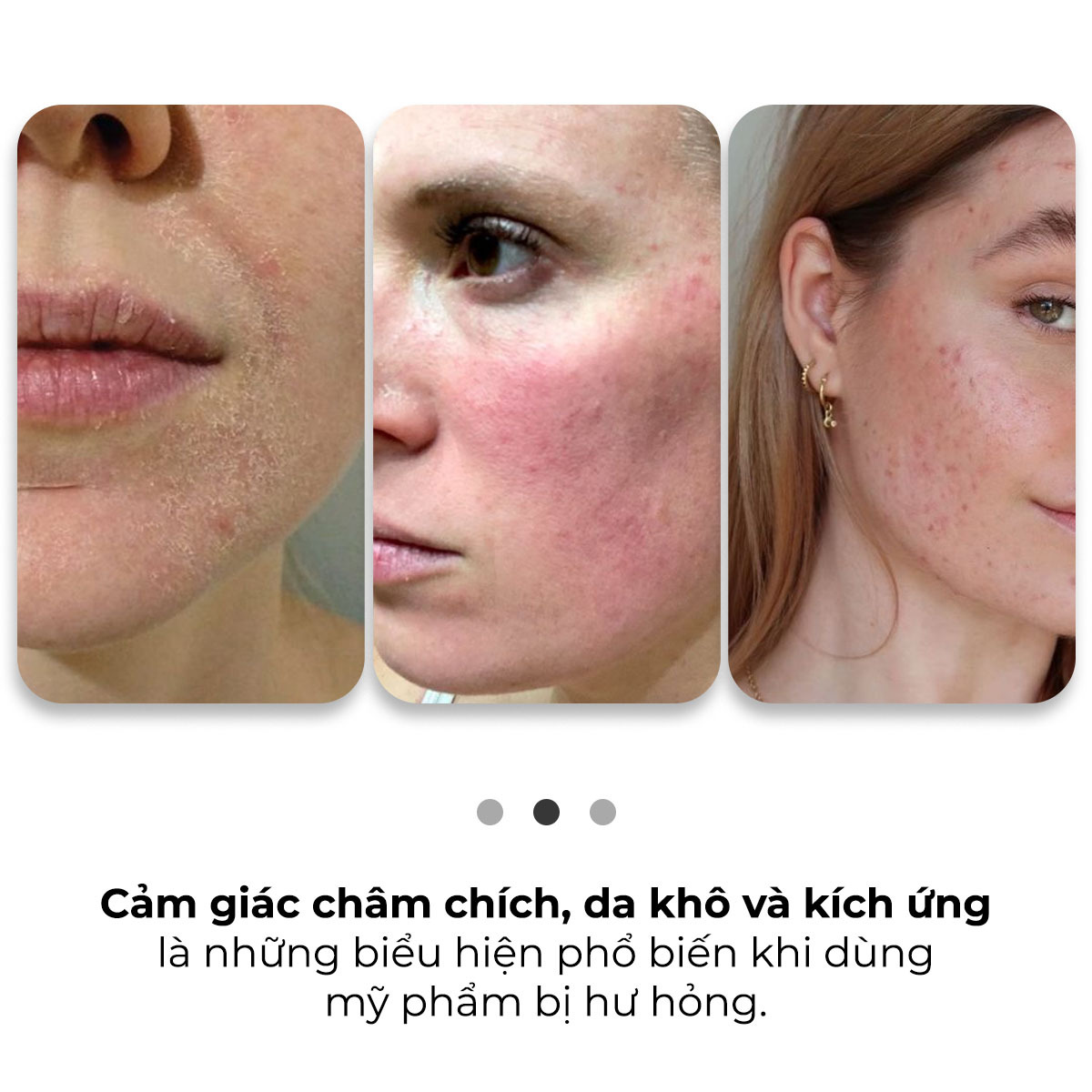 Cảm giác châm chích, da khô và kích ứng là những biểu hiện phổ biến khi dùng mỹ phẩm bị hư hỏng. Khám phá dấu hiệu nhận biết mỹ phẩm hỏng để bảo vệ làn da bạn.