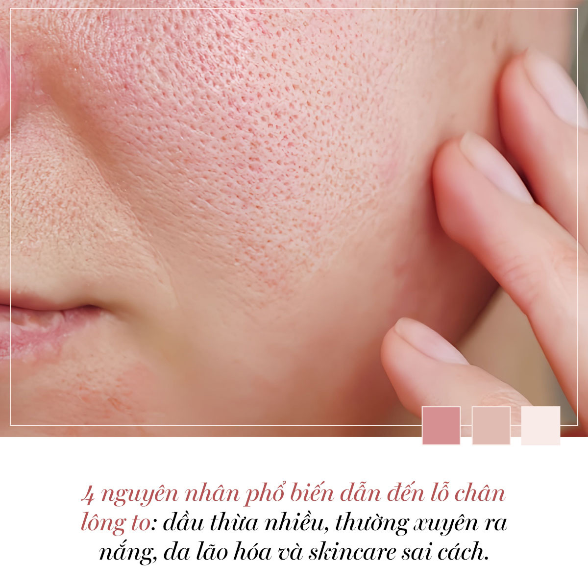 4 nguyên nhân phổ biến dẫn đến lỗ chân lông to: dầu thừa nhiều, thường xuyên ra nắng, da lão hóa và skincare sai cách. Tìm hiểu cách khắc phục lỗ chân lông to cùng Lixibox Magazine!