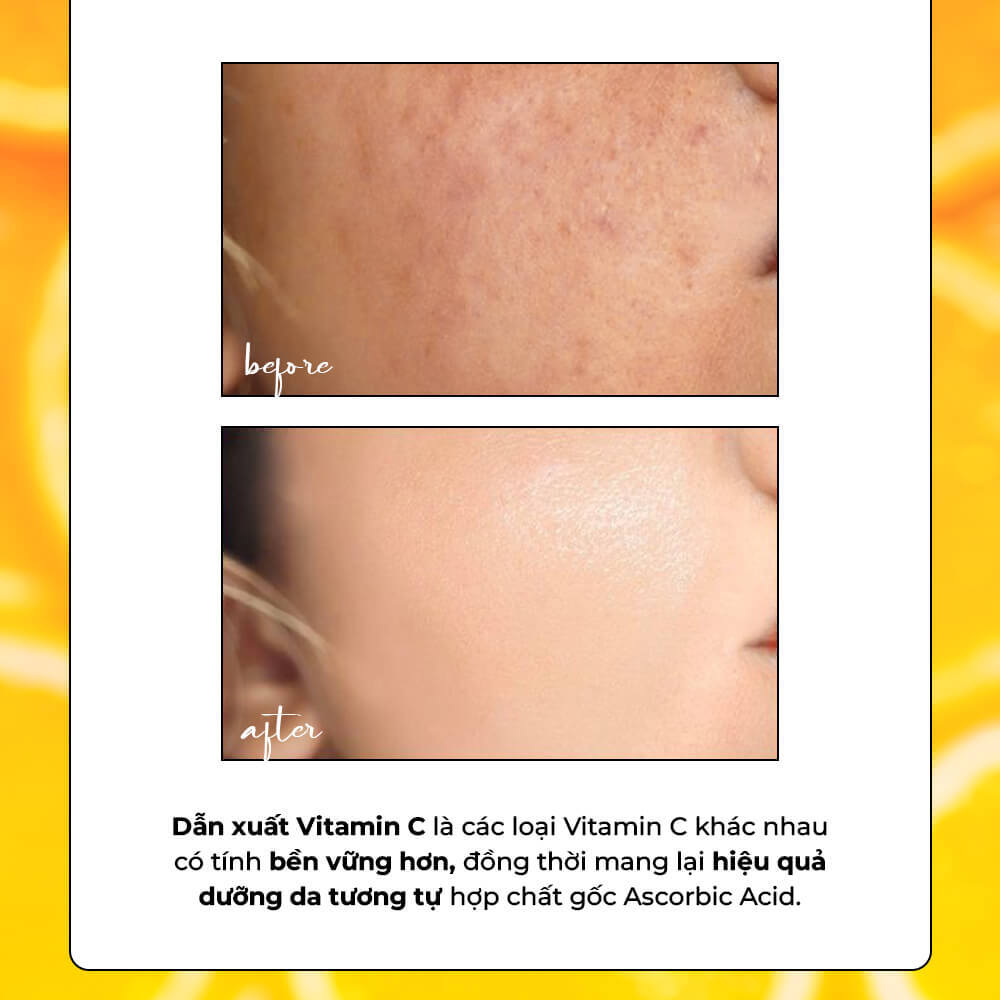 Dẫn xuất Vitamin C thể hiện sự khác biệt giữa làn da trước và sau khi sử dụng, giúp làm sáng da và giảm thâm hiệu quả. Bài viết của Lixibox khám phá các loại dẫn xuất vitamin C tốt nhất cho làn da khỏe mạnh.