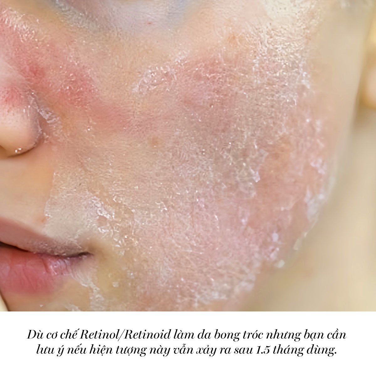 Da mặt có dấu hiệu bong tróc do Retinol/Retinoid gây ra, cần dừng sử dụng ngay để tránh tổn thương. Bài viết của Lixibox khám phá khi nào nên dừng dùng Retinol và các dấu hiệu cần chú ý.