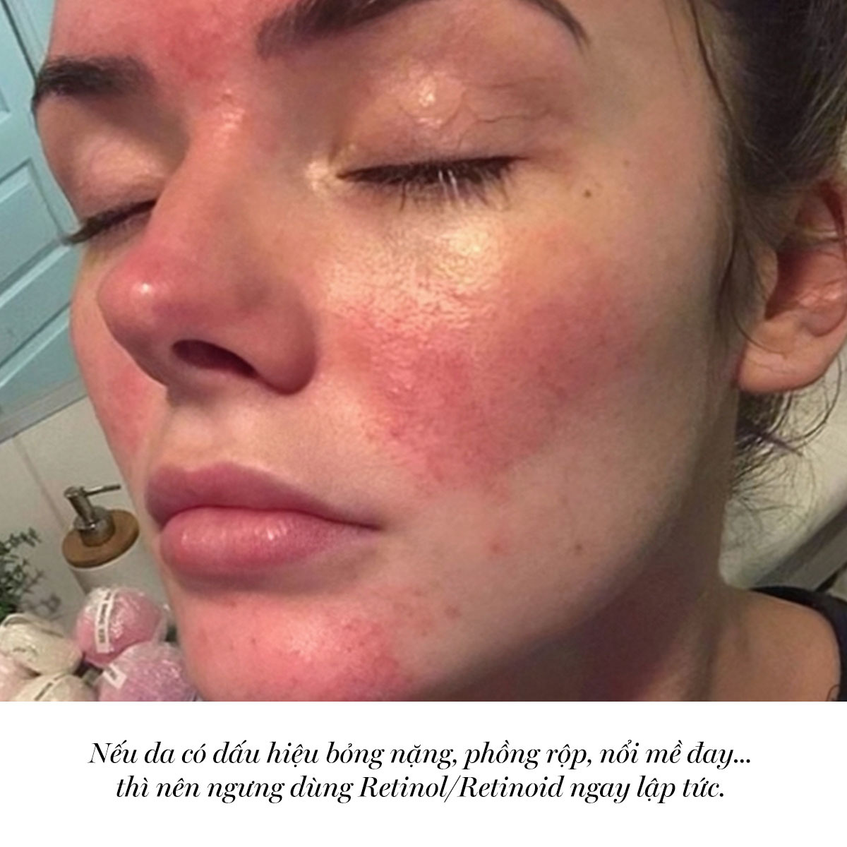 Dấu hiệu cần ngừng dùng Retinol hoặc Retinoid bao gồm da bóng nảy, phỏng rộp, hoặc nỗi mề đây. Bài viết trên Lixibox giải thích khi nào nên dừng dùng Retinol để bảo vệ làn da.
