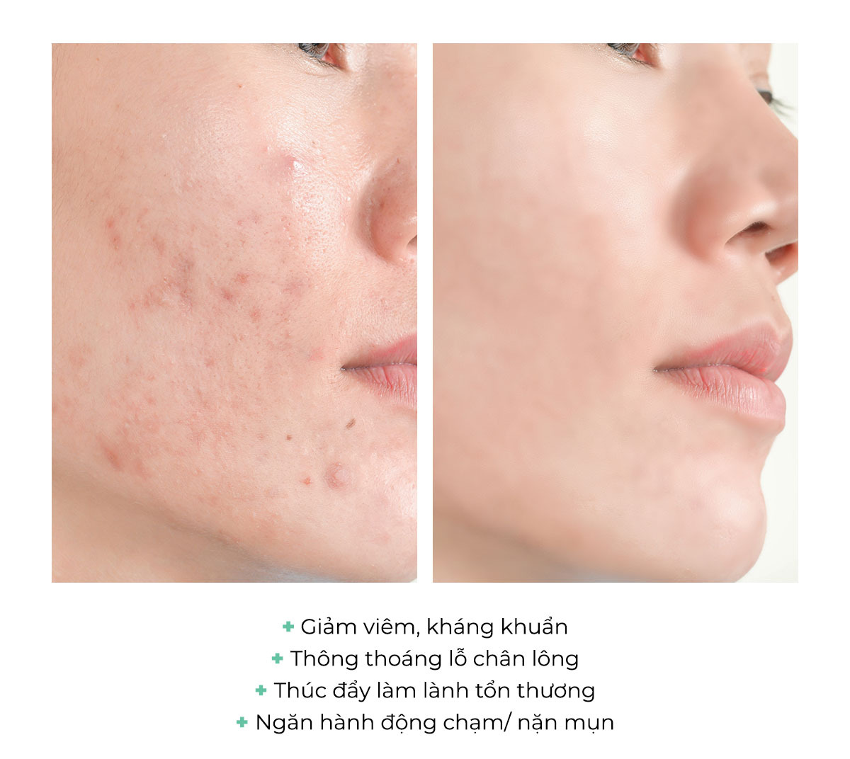 Bài viết về miếng dán mụn từ Lixibox Skincare, cung cấp thông tin về công dụng, hiệu quả và lời khuyên từ chuyên gia về việc sử dụng miếng dán mụn. Nhấn mạnh lợi ích như giảm viêm, kháng khuẩn và hỗ trợ lành mụn.