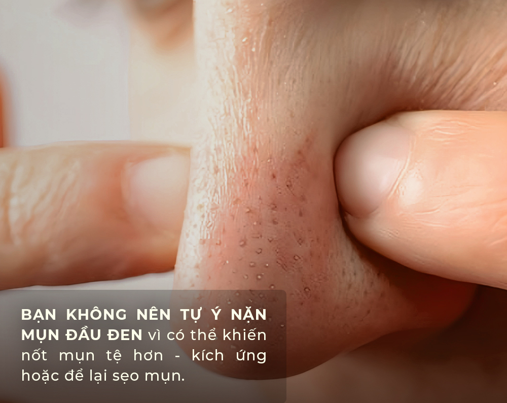 Nội dung bài viết trên Lixibox Skincare nhấn mạnh rằng không nên tự ý nặn mụn đầu đen vì có thể gây kích ứng, làm nốt mụn tệ hơn và có nguy cơ để lại sẹo. Tìm hiểu câu trả lời từ các chuyên gia da liễu.