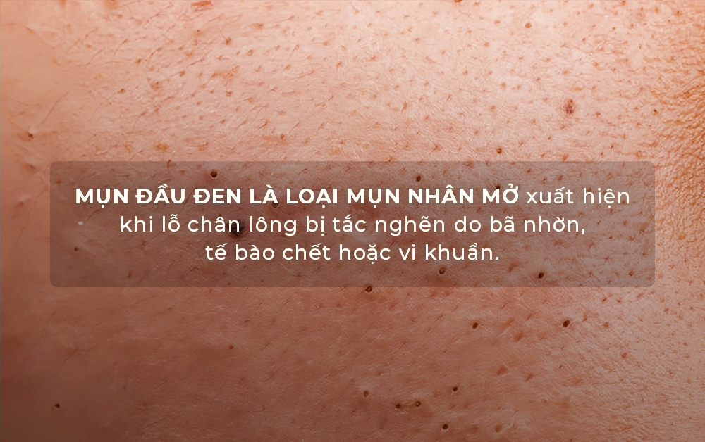 Mụn đầu đen là loại mụn nhấn mở xuất hiện khi lỗ chân lông bị tắc nghẽn do bã nhờn, tế bào chết hoặc vi khuẩn. Bài viết từ Lixibox Skincare giải thích có nên nặn mụn đầu đen không và chia sẻ cách trị mụn đầu đen hiệu quả.