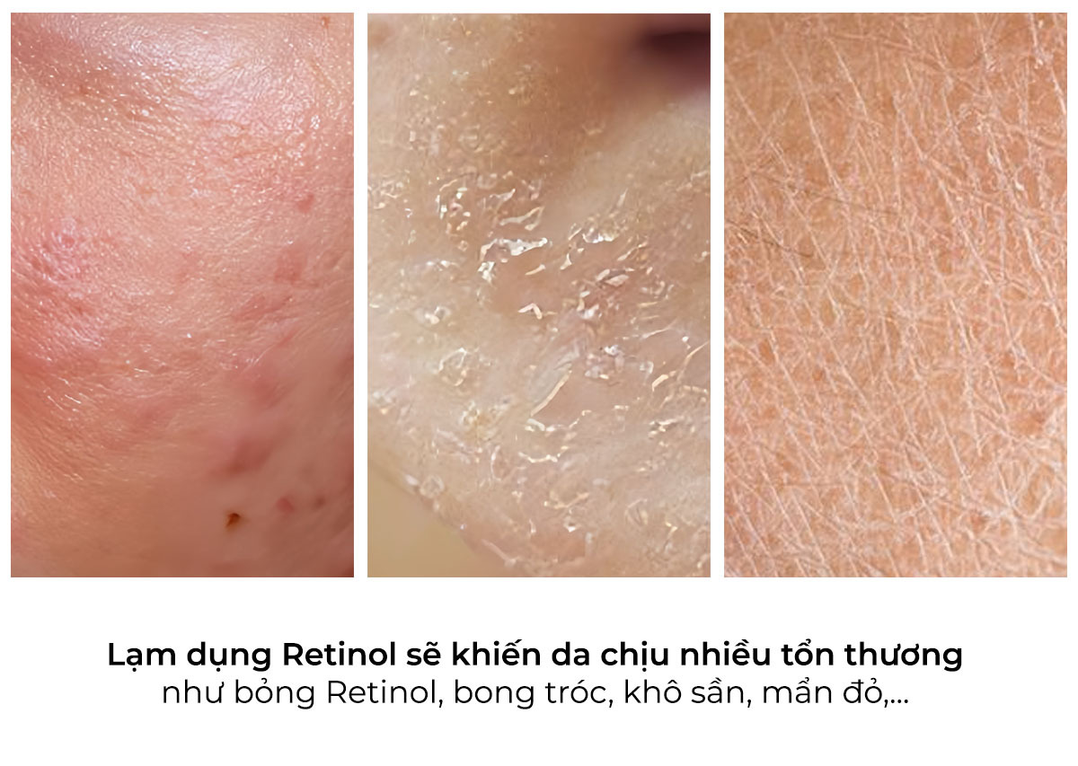 Hình ảnh minh họa tác hại của việc lạm dụng Retinol với làn da, thể hiện tình trạng như bông Retinol, bong tróc, và khô sần. Bài viết cung cấp thông tin về lượng dùng Retinol hợp lý trong chăm sóc da.