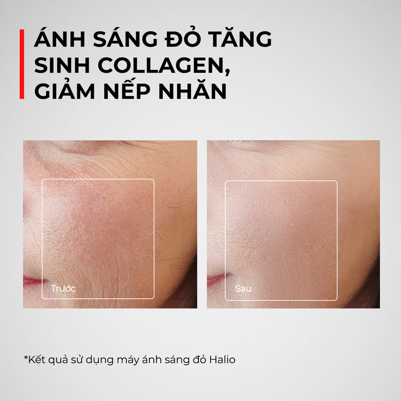 Ánh sáng đỏ tăng sinh collagen, giảm nếp nhăn - Kết quả sau điều trị bằng máy ánh sáng đỏ Halio. Ánh sáng sinh học là mà phương pháp làm đẹp hiện đại, hỗ trợ nâng cơ và căng da, đem lại làn da khỏe mạnh.