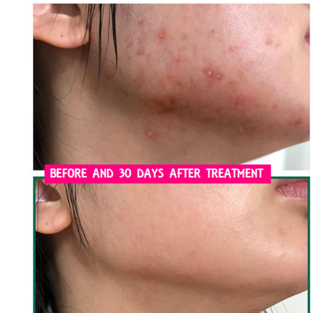 Trước và sau 30 ngày điều trị, cho thấy sự cải thiện rõ rệt của làn da. Khám phá bí quyết chăm sóc da với sản phẩm skincare nổi bật nhất 2018, giúp da sạch, da đẹp và thu nhỏ lỗ chân lông.