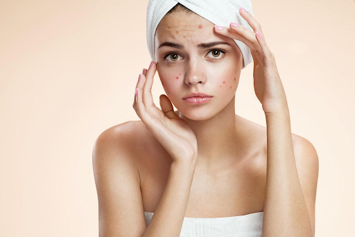 Muốn mụn nhanh khô, hãy ghi nhớ 5 nguyên tắc xây dựng skin care routine chuẩn cho da mụn. Bài viết cung cấp thông tin khoa học về chăm sóc da mụn, giúp bạn lựa chọn phương pháp hiệu quả nhất.