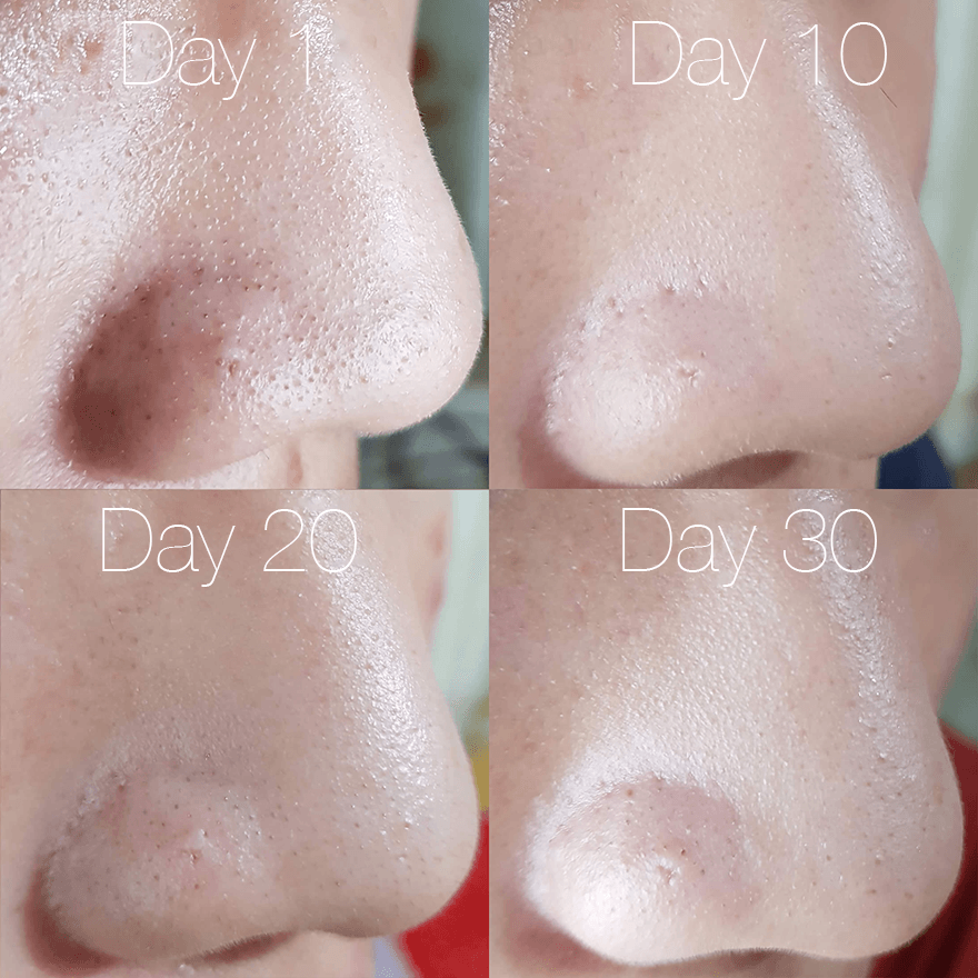 Hình ảnh trình bày kết quả trị mụn sau 30 ngày sử dụng nước hoa hồng Some By Mi, từ mụn đầu đen, mụn ẩn đến da nhạy cảm, với sự thay đổi rõ rệt trong 4 giai đoạn: Ngày 1, 10, 20 và 30.