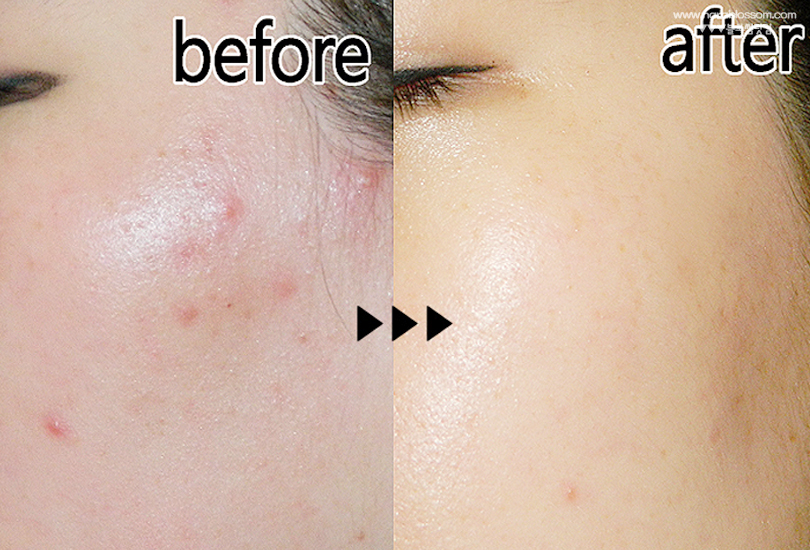 Hình ảnh so sánh làn da trước và sau khi sử dụng Bakuchiol, một lựa chọn thay thế Retinol an toàn cho da nhạy cảm, giúp trị mụn và chống lão hóa hiệu quả, đặc biệt cho làn da bị kích ứng.