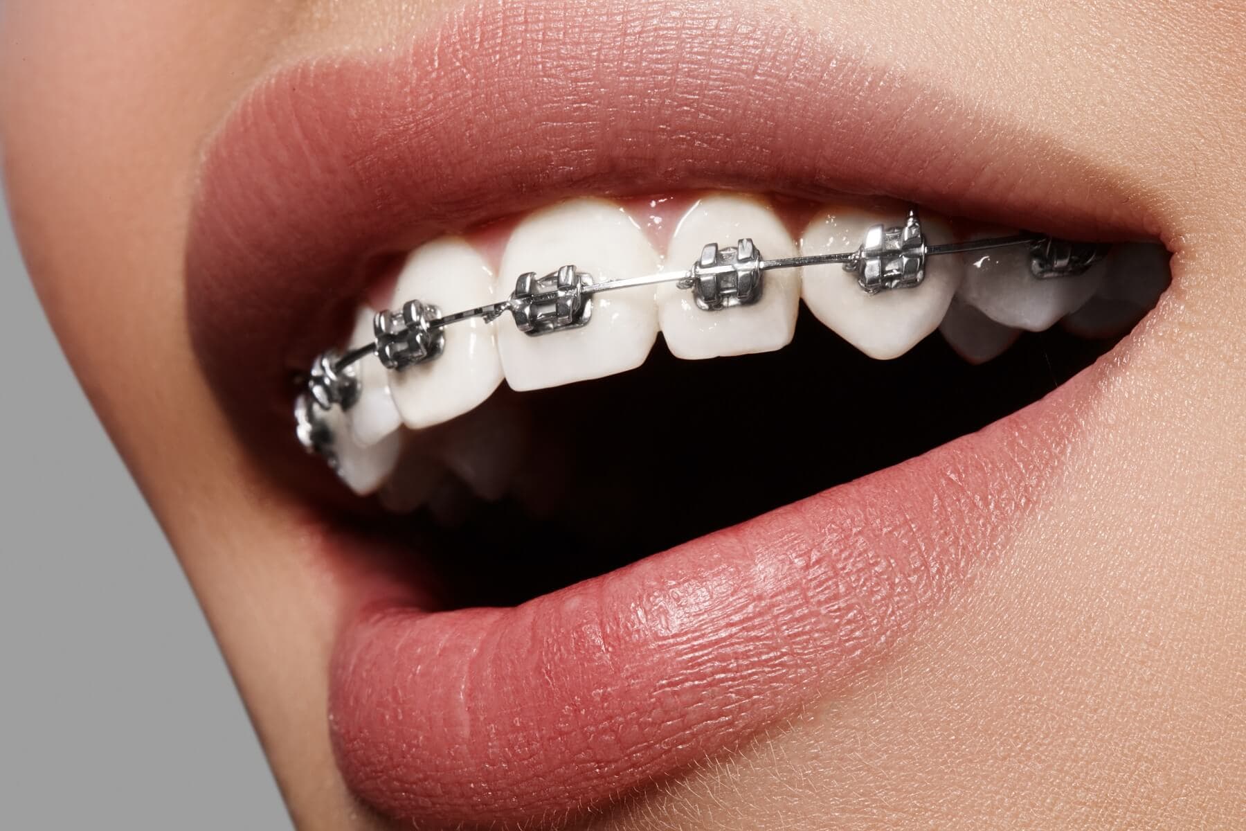Chăm sóc răng miệng trong quá trình niềng răng với 3 sản phẩm quan trọng: bàn chải điện Halio Sonic, máy tăm nước, và các biện pháp làm trắng răng. Giúp vệ sinh răng hiệu quả hơn và duy trì nụ cười rạng rỡ.