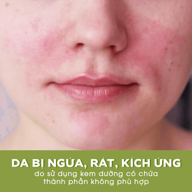 Da nhạy cảm bị ngứa, rát, kích ứng do sử dụng kem dưỡng không phù hợp. Bài viết khám phá 4 sai lầm khi chọn kem dưỡng để cải thiện tình trạng chăm sóc da nhạy cảm.