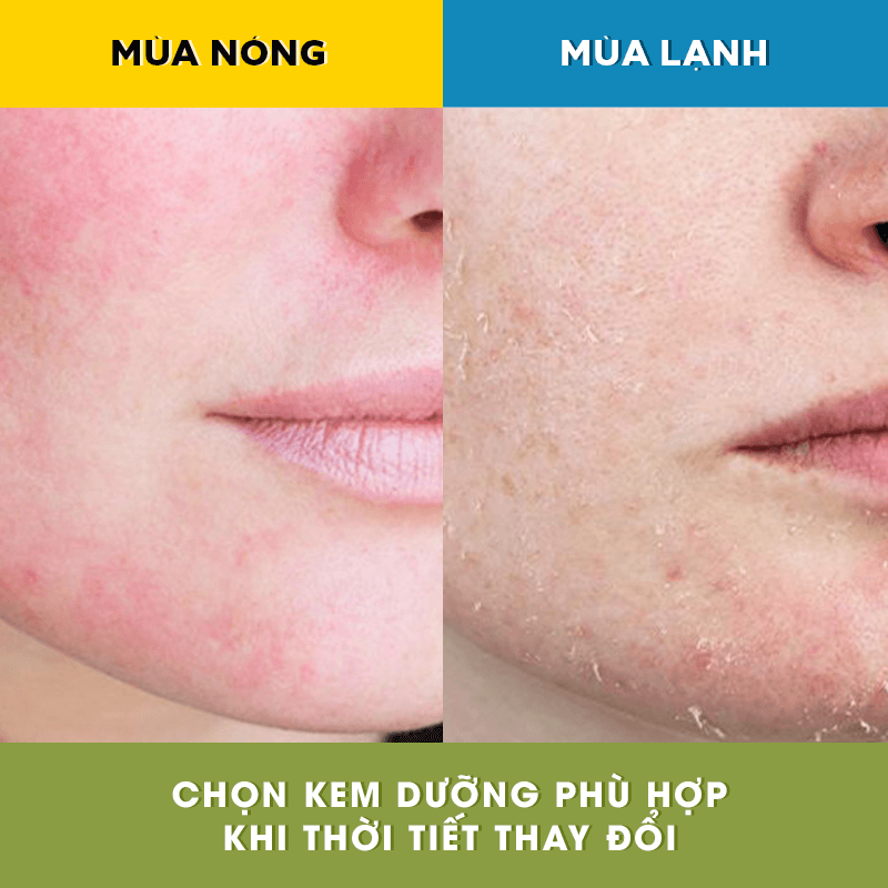 Bức ảnh so sánh làn da trong mùa nóng và mùa lạnh, với làn da nhạy cảm ửng đỏ ở bên trái và làn da bong tróc ở bên phải. Chọn kem dưỡng phù hợp khi thời tiết thay đổi để bảo vệ làn da, tránh 4 sai lầm khi chăm sóc da nhạy cảm. Nguyễn tắm cho làn da thêm khỏe mạnh, hấp thụ dưỡng chất tốt hơn.