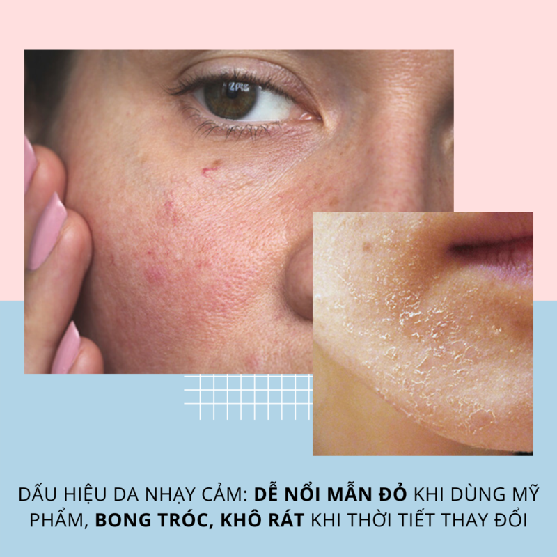 Dấu hiệu da nhạy cảm: dễ nổi mẩn đỏ khi dùng mỹ phẩm, bong tróc, khô rát khi thời tiết thay đổi. Tìm hiểu về chăm sóc da nhạy cảm và các yếu tố ảnh hưởng từ OKAME Skincare, Halio Sensitive.