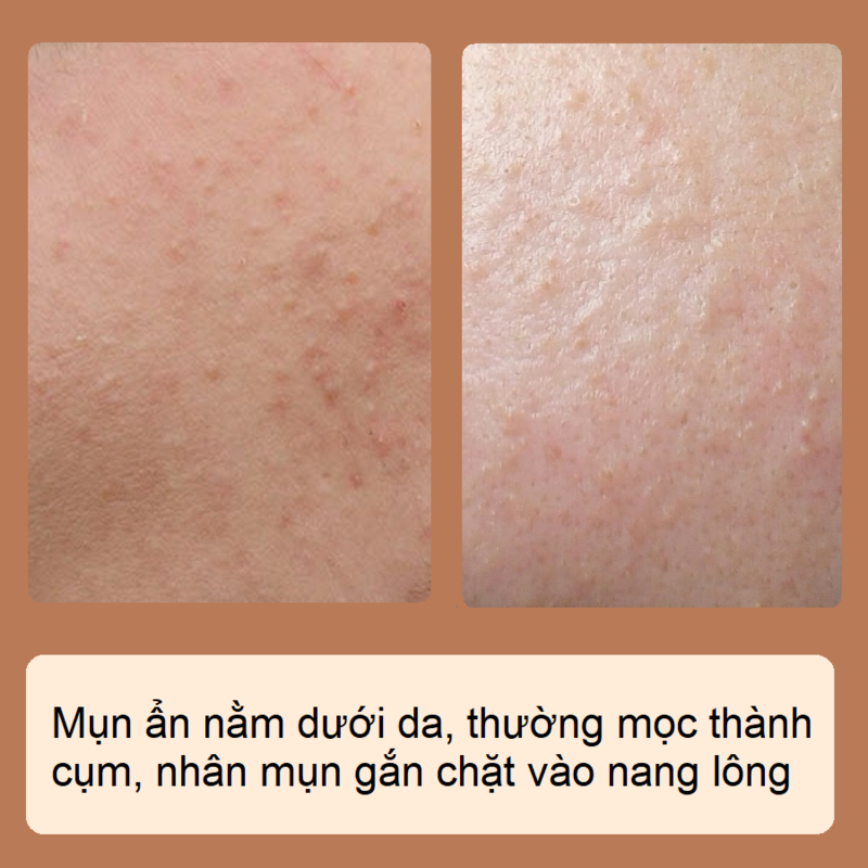 Mụn ẩn nằm dưới da, thường mọc thành cụm, nhân mụn gắn chặt vào nang lông. Cùng tìm hiểu mụn ẩn có tự biến mất không và cách điều trị hiệu quả với mỹ phẩm trị mụn.