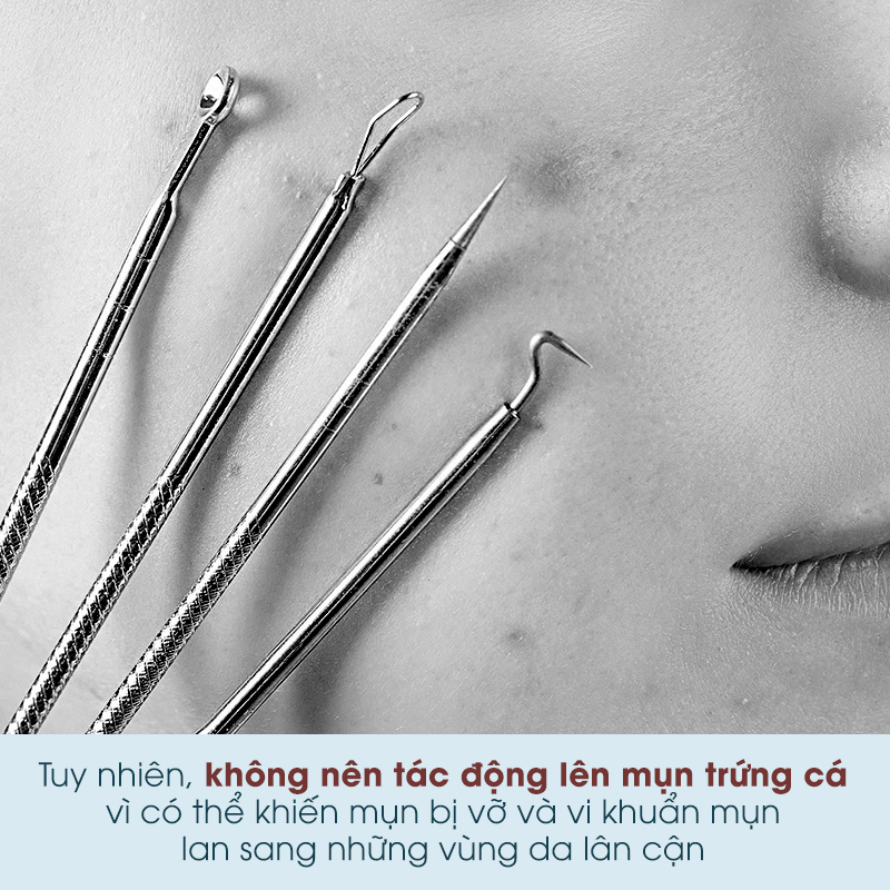 Tuy nhiên, không nên tác động lên mụn trứng cá vì có thể khiến mụn bị vỡ và vi khuẩn mụn lan sang những vùng da lân cận. Khám phá mụn trứng cá có lây không và cách trị mụn trứng cá hiệu quả.