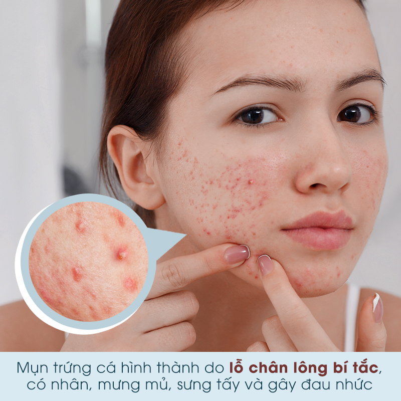 Cô gái trẻ để lộ làn da bị mụn trứng cá với nhiều nốt đỏ, tấy trên má và trán. Hình ảnh minh họa cho bài viết về việc mụn trứng cá có lây không và cách trị mụn trứng cá hiệu quả.