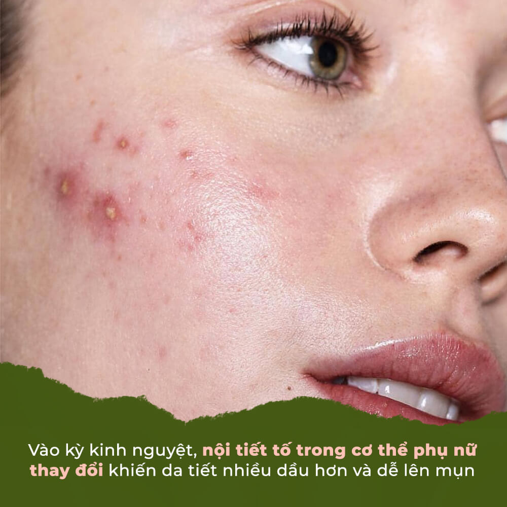 Bài viết chia sẻ bí quyết chăm sóc da mụn trong ngày "đèn đỏ". Khi nội tiết tố thay đổi, da dễ tiết dầu và nổi mụn hơn. Nắm vững mẹo trị mụn và dưỡng da để có làn da khỏe mạnh.