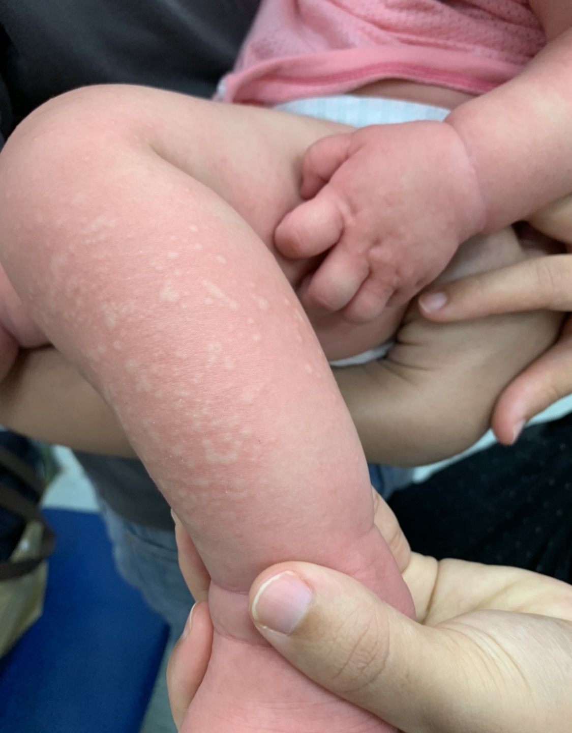 第一次吃蛋 11月女嬰誘發急性蕁麻疹 嘴唇腫脹 嬰兒與母親