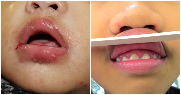 幼兒疱疹性齒齦炎倍增 疑是成人壓力大傳染 嬰兒與母親