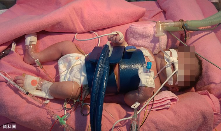 38週胎動異常急剖腹 寶寶缺氧腦病變 低溫成救命關鍵 嬰兒與母親
