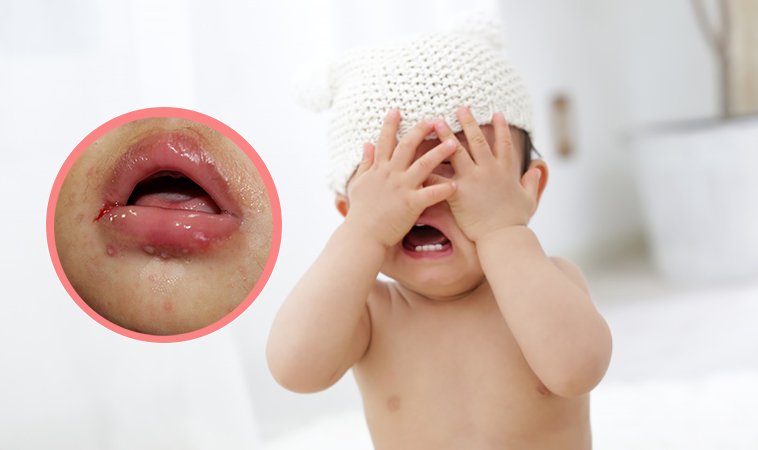 幼兒疱疹性齒齦炎倍增 疑是成人壓力大傳染 嬰兒與母親