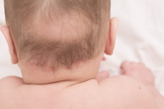 Alopecia Areata ทำน้องผมร่วง