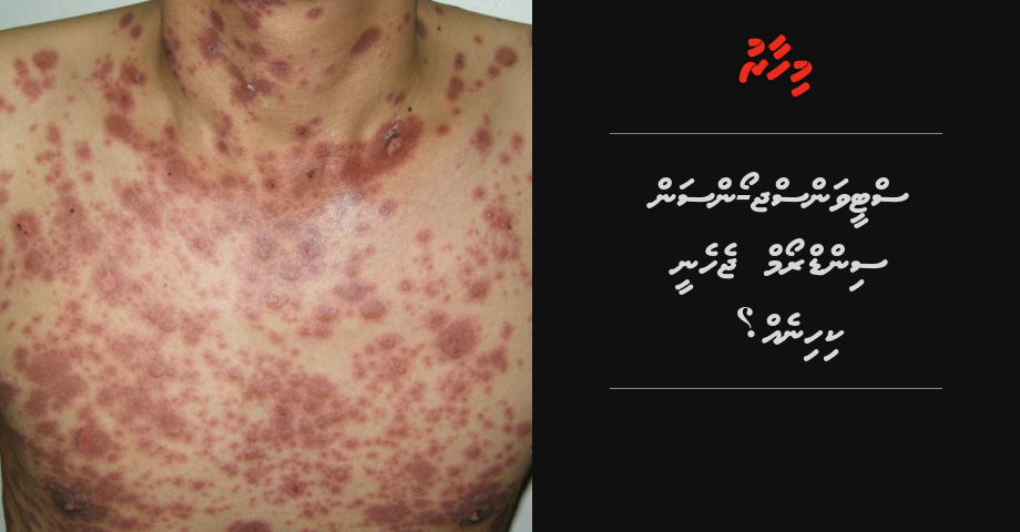 Stevens-Johnson syndrome akee koba?