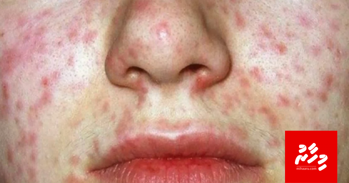 3 vana meehakah himabihi jehijje