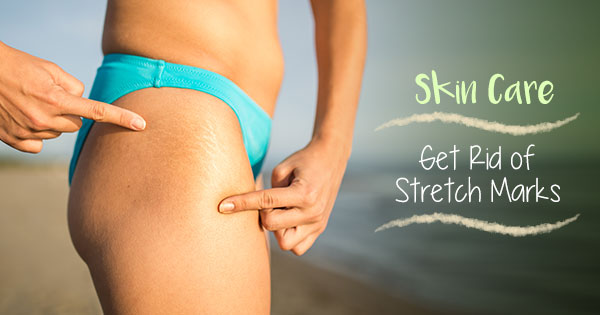 Skin Care: Get Rid of Stretch Marks