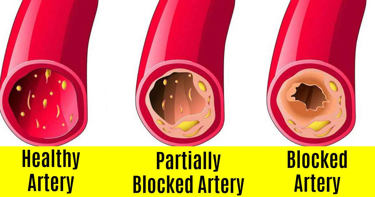 Fat around arteries may be good for health