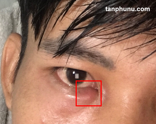 Viêm Tuyến Lệ ở mắt và cách điều trị.jpg