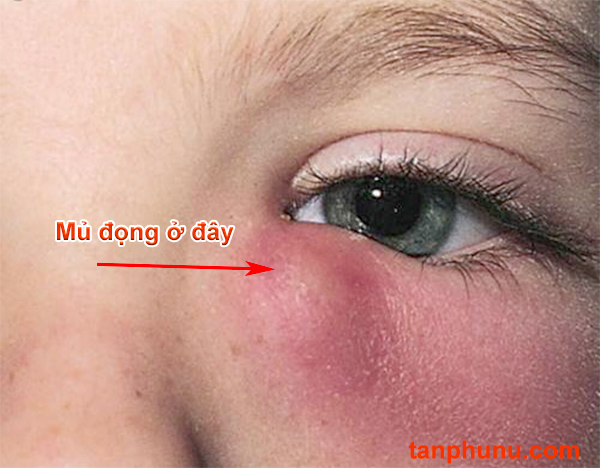 Cách điều trị viêm tuyến lệ ở nhà hiệu quả.jpg