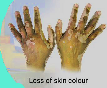 vitiligo1531457140.jpg image