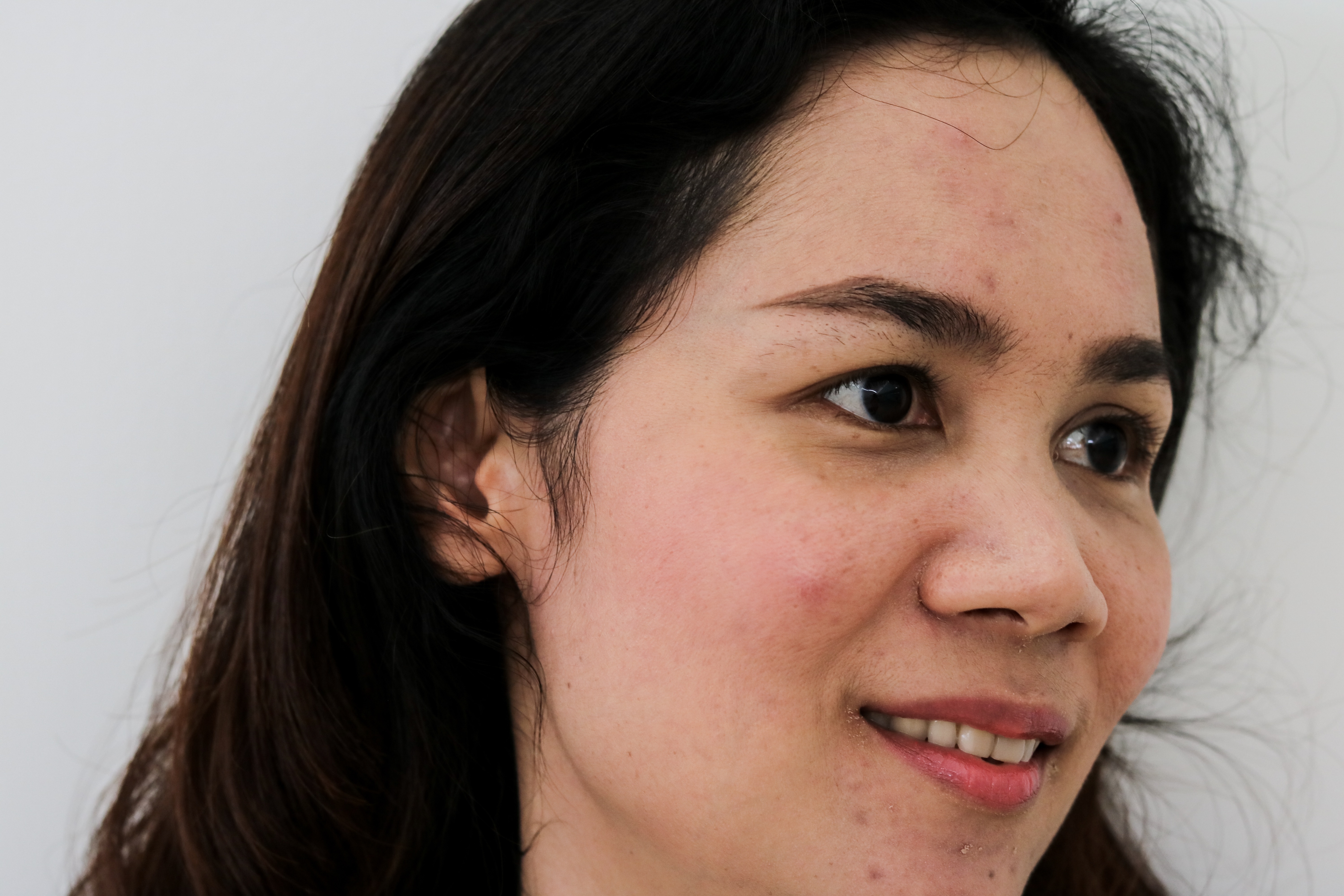 3 Jurus Jitu Atasi Bekas Jerawat Beauty JournalBeauty Journal