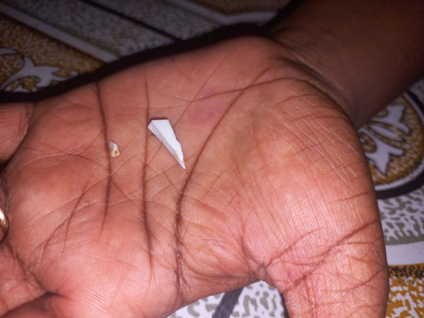 Young Boy Cuts Mouth On Porcelain Shard In Store bought Short Eat 