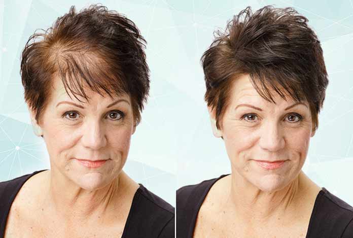 7-Most-Effective-Home-Remedies-for-Hair-Thinning 7 Most Effective Home Remedies for Hair Thinning