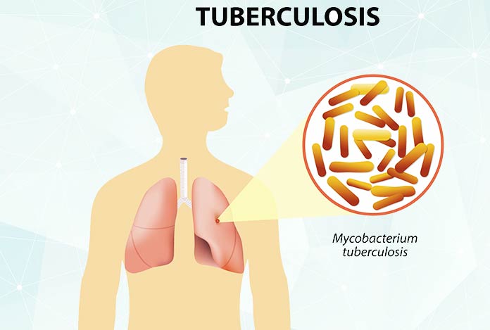 Tuberculosis-Causes-Symptoms-and-Treatment Tuberculosis types symptoms causes and treatment