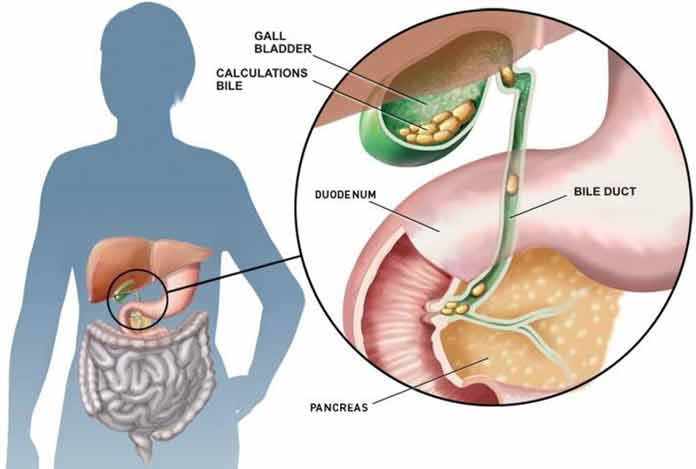 Gallstones-Cholelithiasis-and-its-Most-Common-Drug-List Gallstones Cholelithiasis and its Most Common Drug List