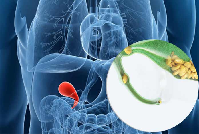 Gallstones Gallstones