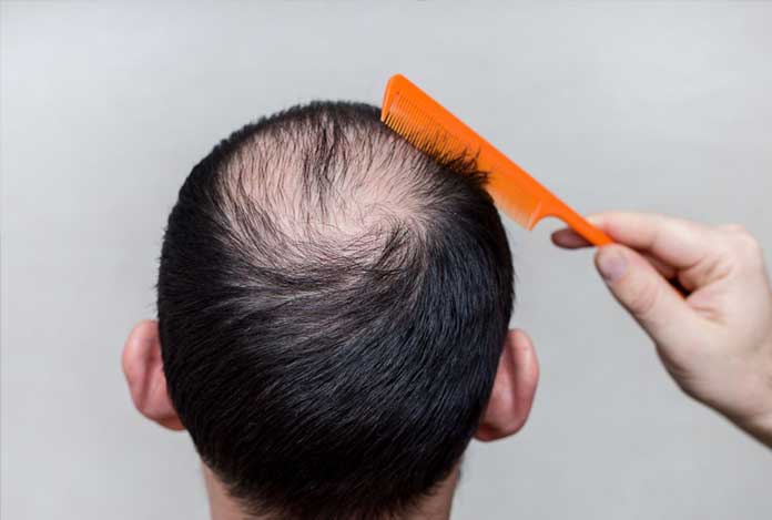 Alopecia Alopecia