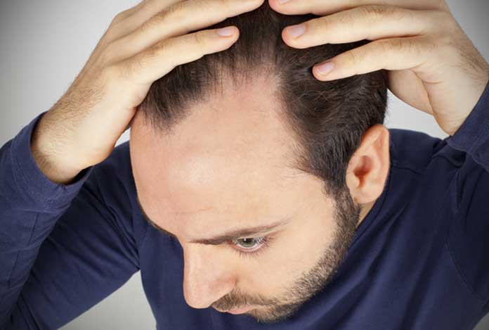 Male Pattern Baldness Male Pattern Baldness